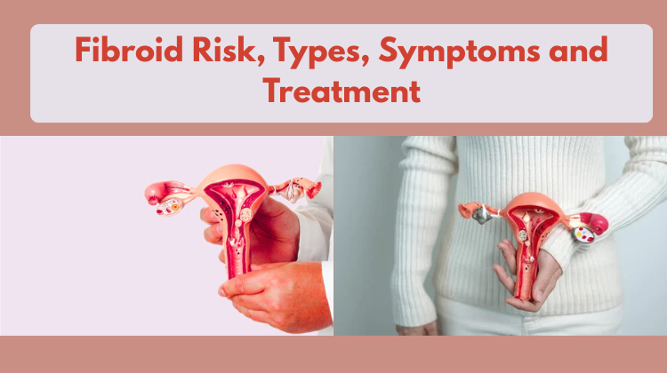 Fibroid Risk,Types, Symptoms and Treatment