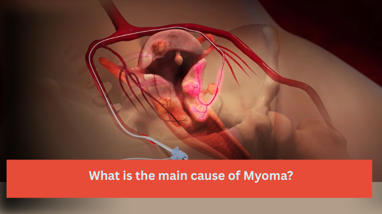 What is the main cause of myoma?